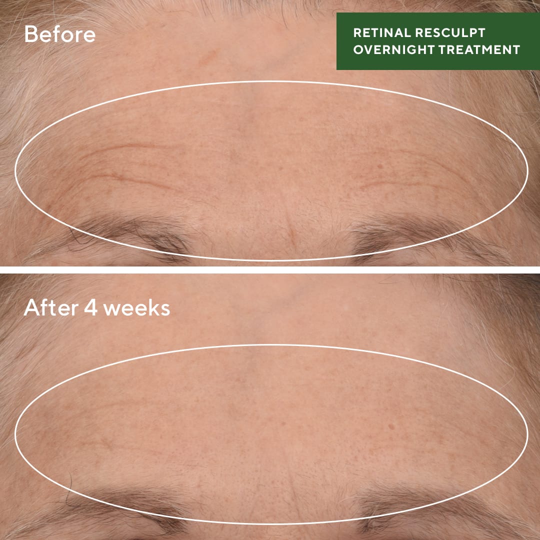 Resurgence: Retinal ReSculpt Treatment
